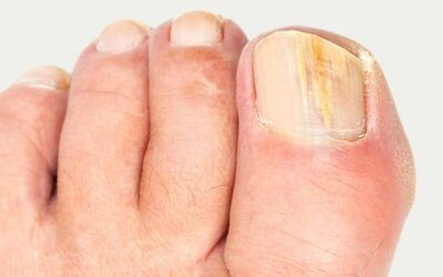 How to Deal with Fungal Toenails